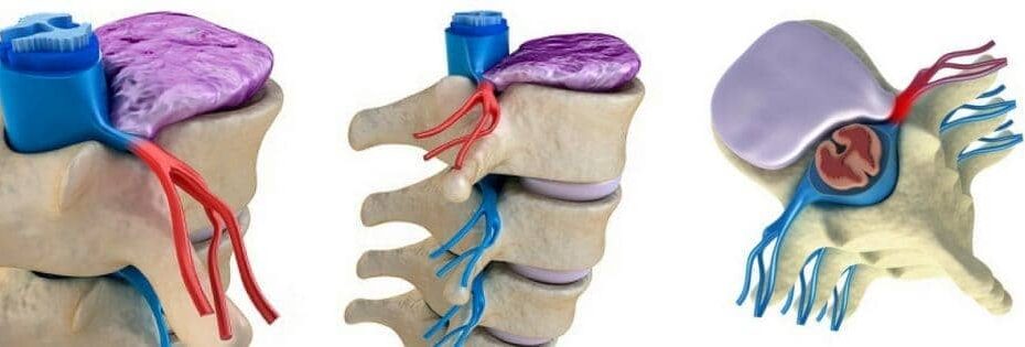 hernia discal y el mejor tratamiento